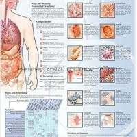 SEXUALLY TRANSMITTED INFECTIONS(STIs--3D RELIEF WALL MEDICAL/PHARMA CHART/POSTER