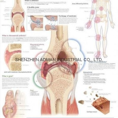 UNDERSTANDING ARTHRITIS--3D RELIEF WALL MEDICAL/PHARMA CHART/POSTERpicture1