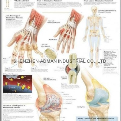 RHEUMATOID ARTHRITIS--3D RELIEF WALL MEDICAL/PHARMA CHART/POSTERpicture1