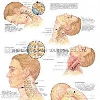 Whiplash Injuries of the Head and Nec-3D RELIEF WALL MEDICAL/PHARMA CHART/POSTER
